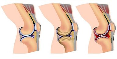 ขั้นตอนของการพัฒนาของ arthrosis ของข้อเข่า